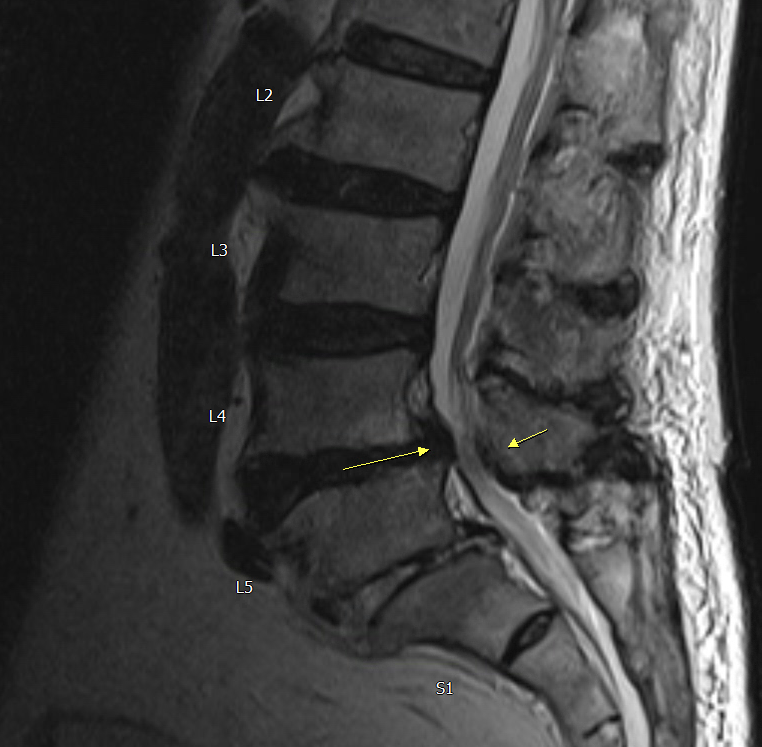 86歲長者術前腰椎 MRI 顯示第四、第五腰椎神經壓迫病灶