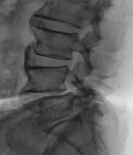 86歲長者術前腰椎 X 光顯示多節段退化