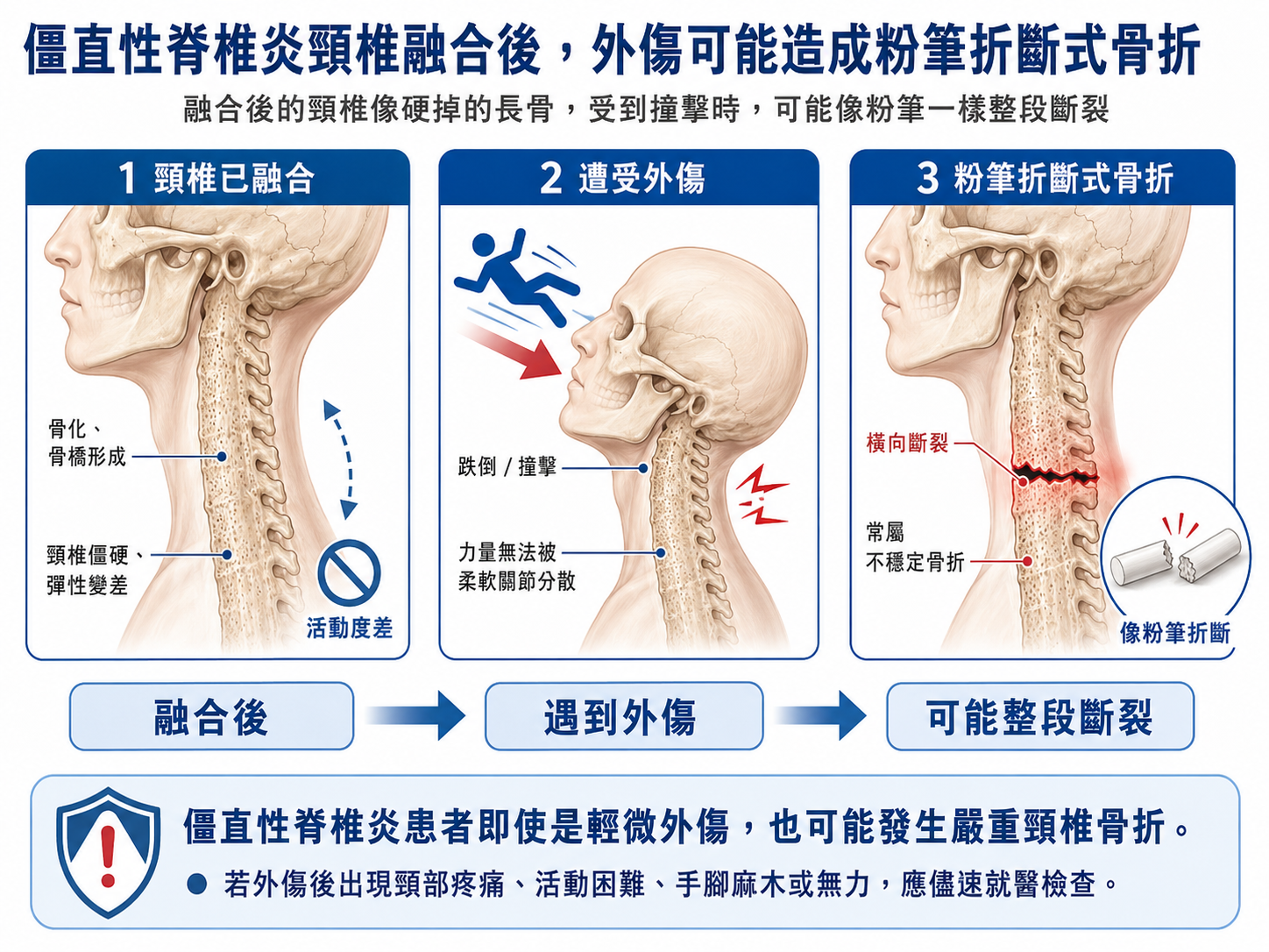 僵直性脊椎炎頸椎融合後外傷可能造成粉筆折斷式骨折專訪文章封面