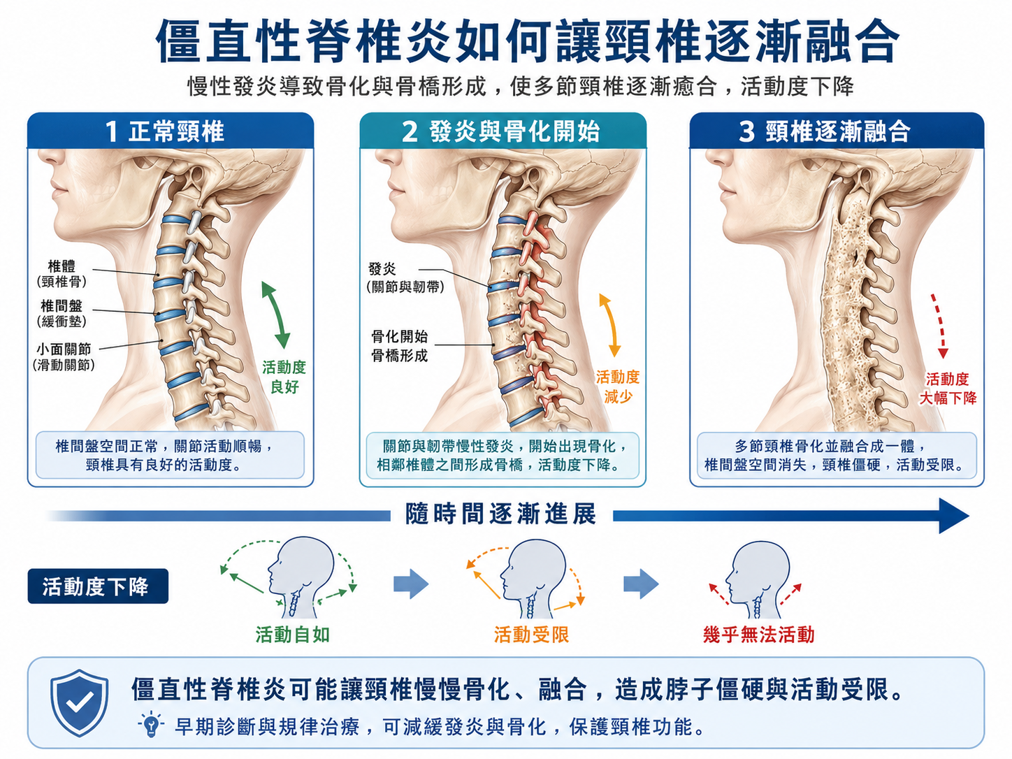 僵直性脊椎炎造成頸椎逐漸融合與活動度下降示意圖