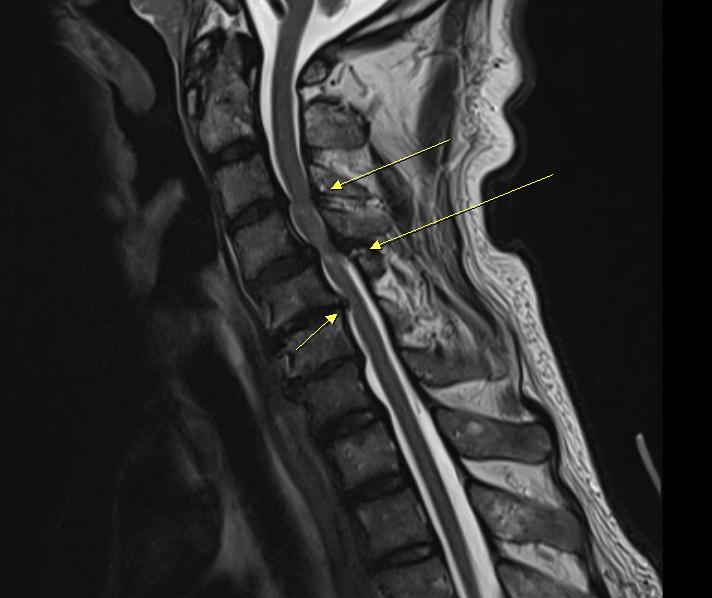 頸椎多節段狹窄壓迫術前 MRI 影像專訪文章封面