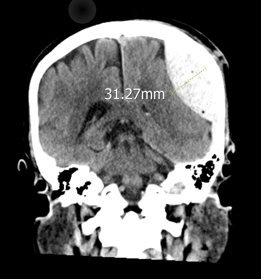 冠狀切面顯示外傷性硬腦膜上出血血塊厚度的 CT 影像