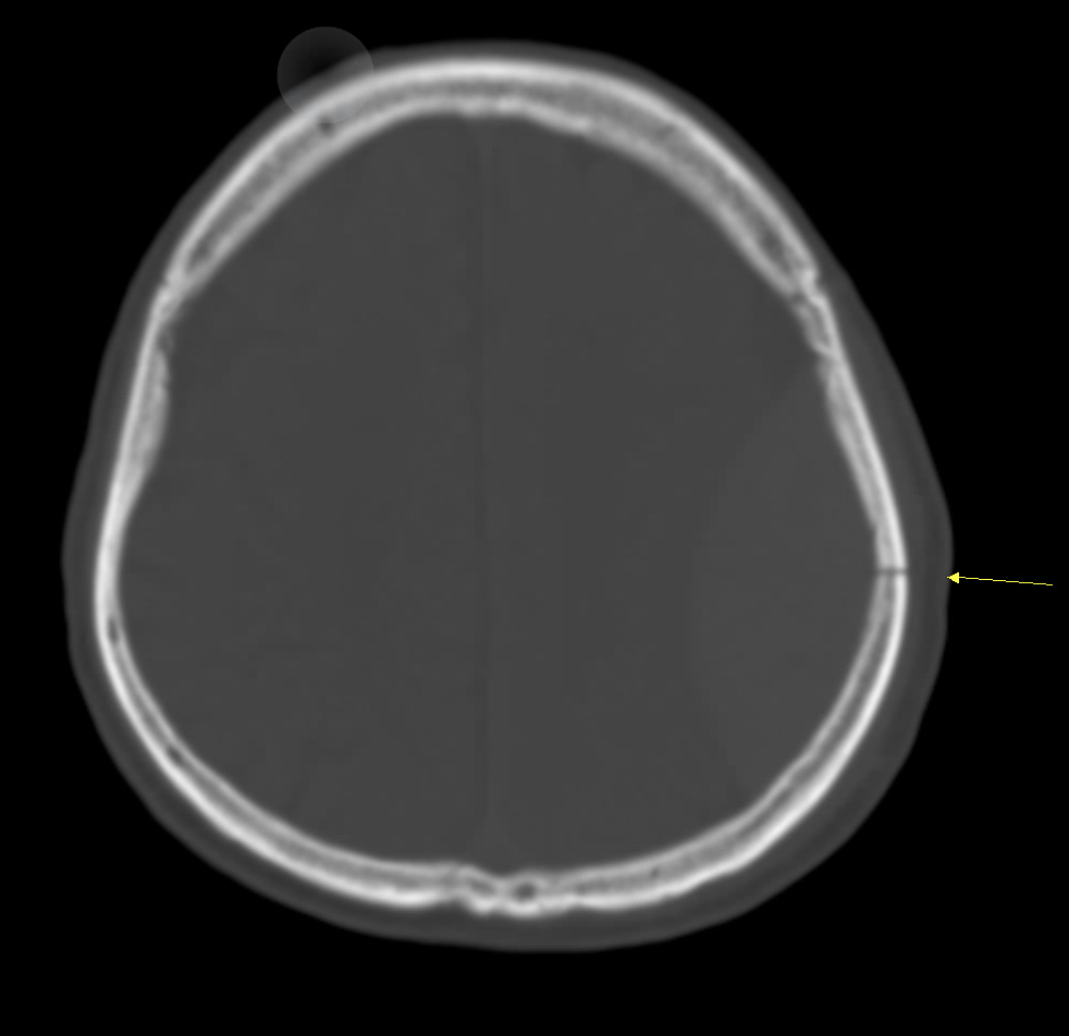 外傷性硬腦膜上出血合併顱骨骨折的 CT 骨窗影像