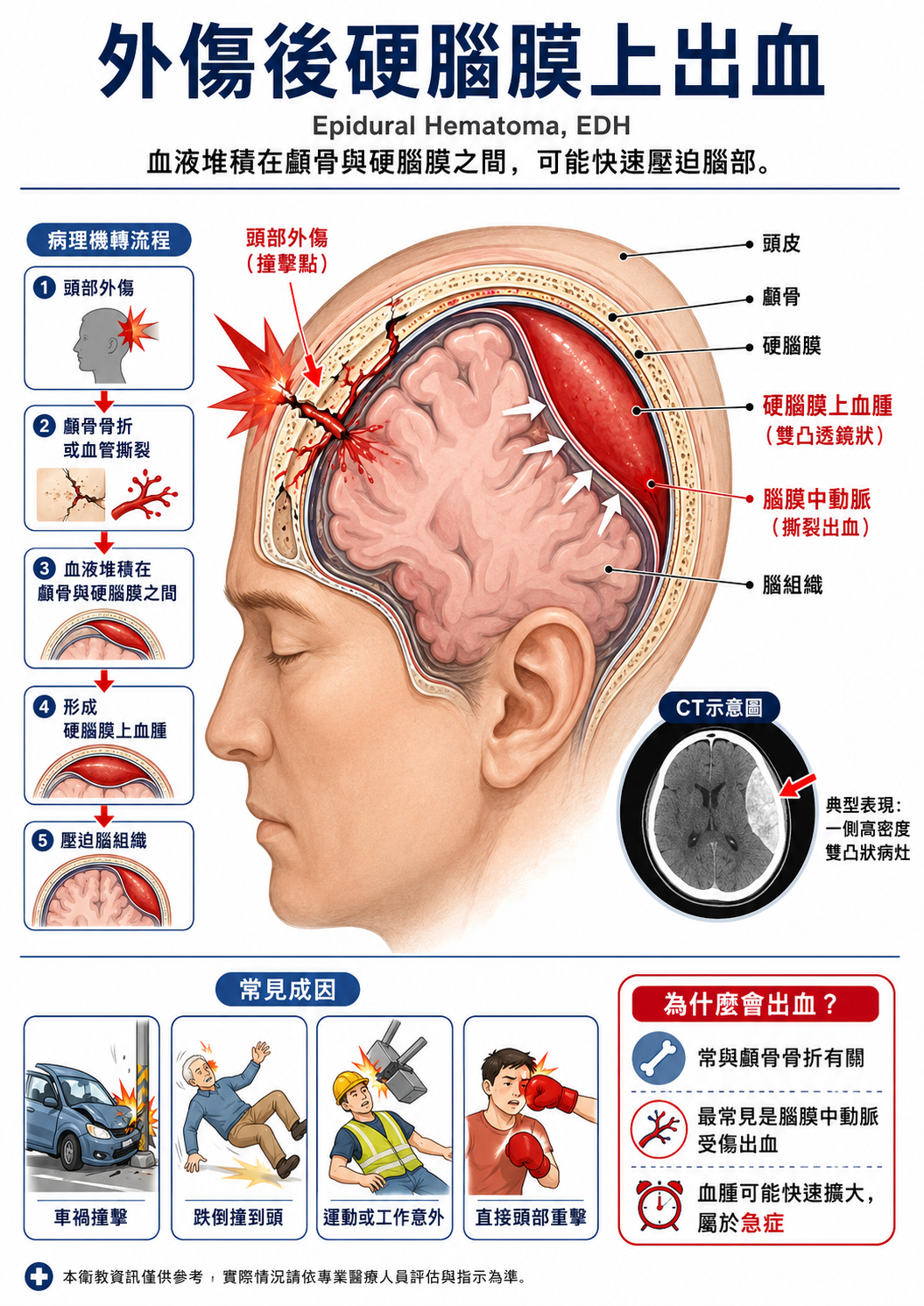 外傷後硬腦膜上出血形成機轉與常見原因示意圖