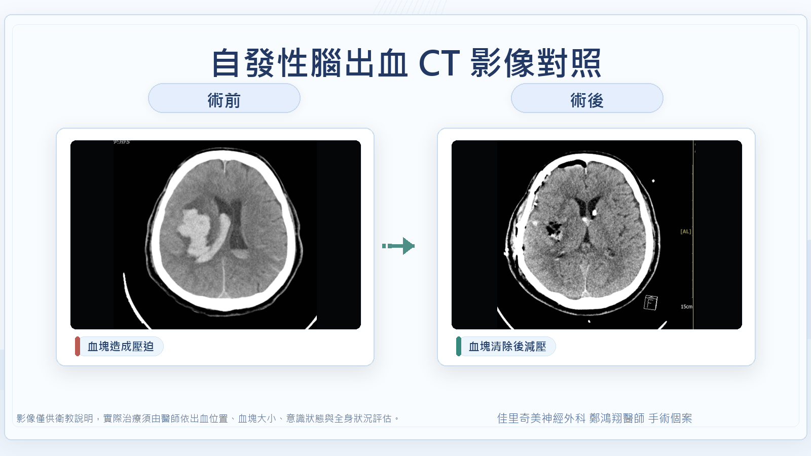 自發性腦出血術前術後 CT 影像對照