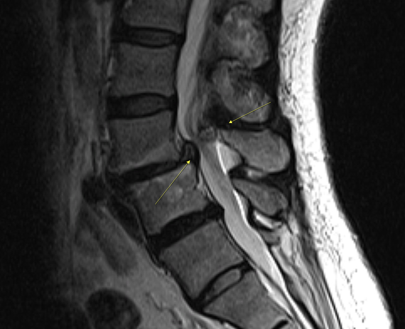 術前腰椎 MRI，箭頭標示腰椎退化、滑脫與神經壓迫位置