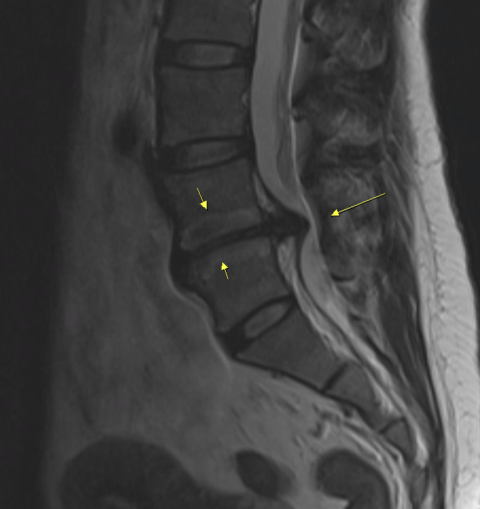 腰椎椎間盤突出導致椎管狹窄的術前 MRI 專訪文章封面