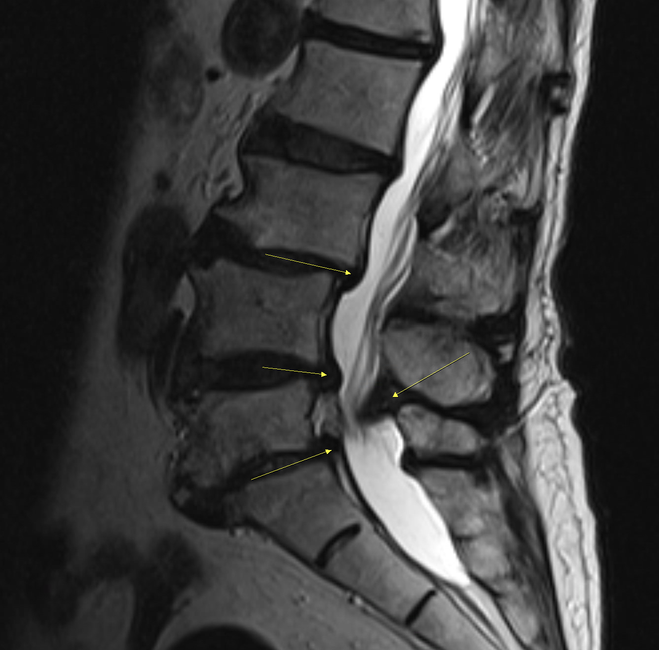 多節段腰椎退化與神經壓迫 MRI 影像