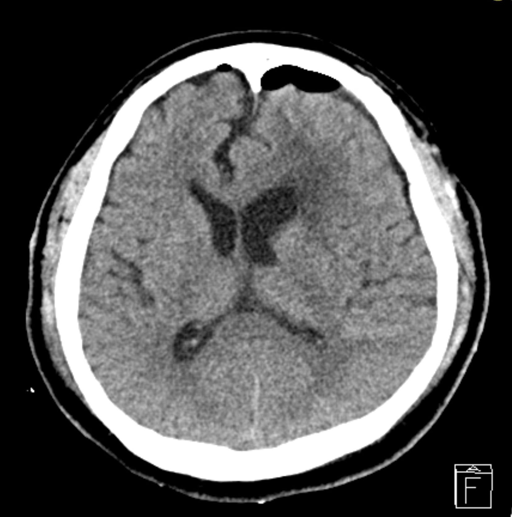 巨大腦膜瘤術後影像
