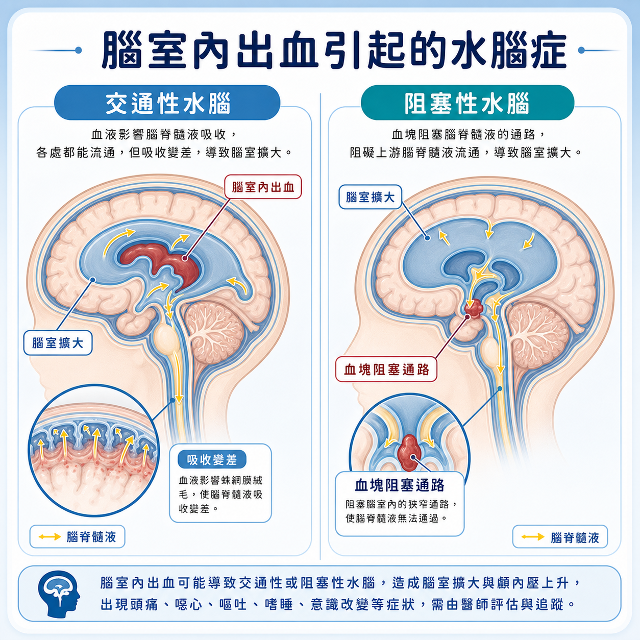 腦室內出血後交通性與阻塞性水腦症示意圖