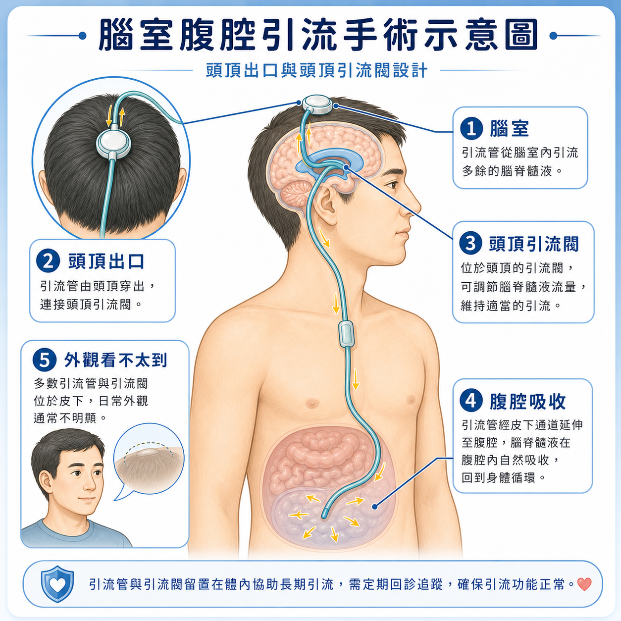 成人 VP Shunt 頭頂出口與引流閥外觀示意圖