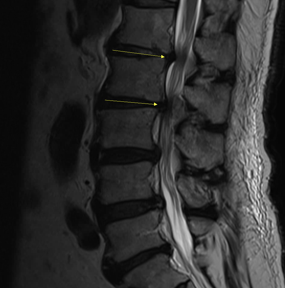鈦塗層複合式椎籠融合手術後腰椎MRI