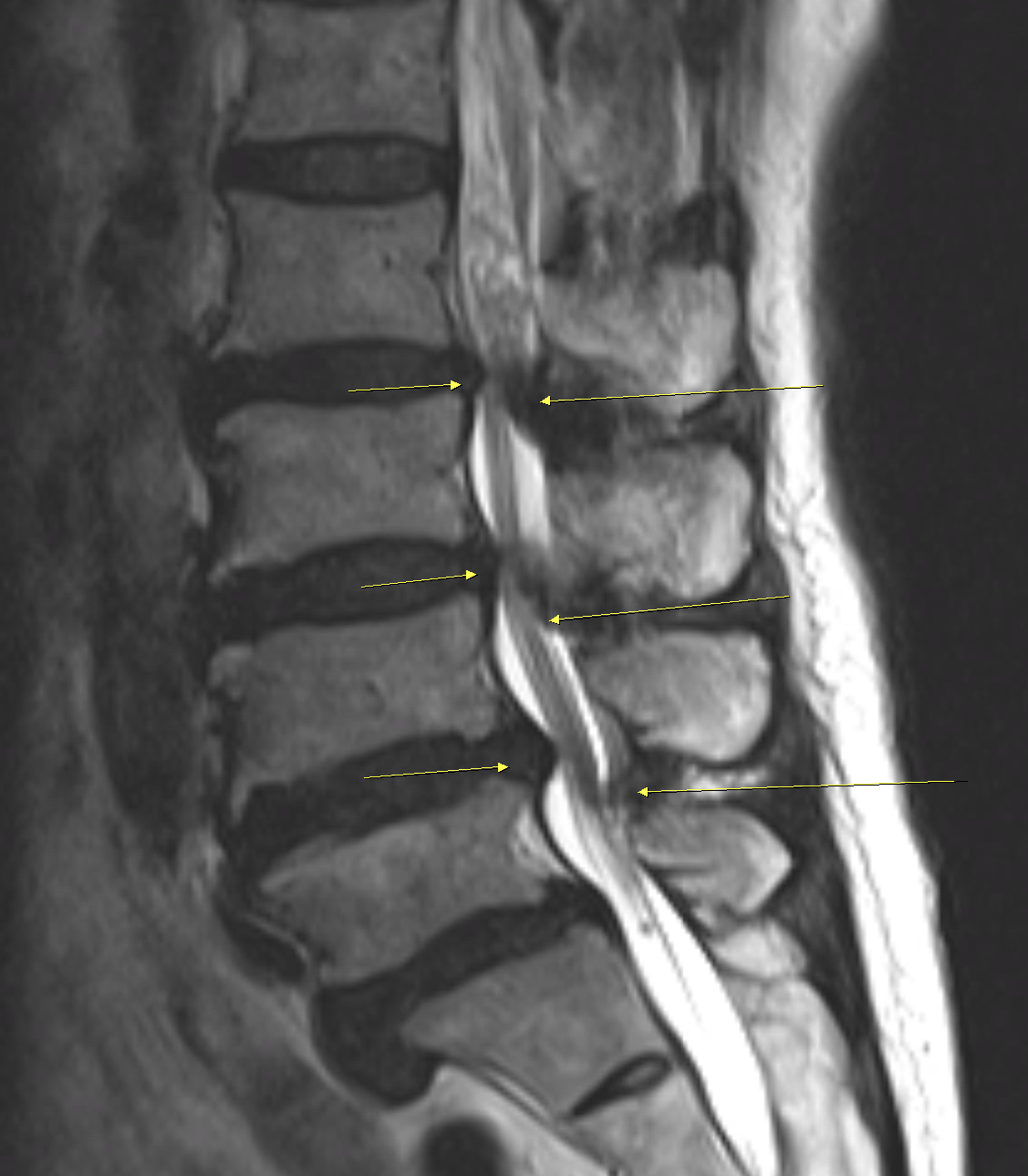 可擴張式椎籠融合手術前後評估腰椎MRI