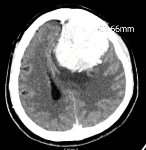 巨大腦膜瘤術前腦部影像