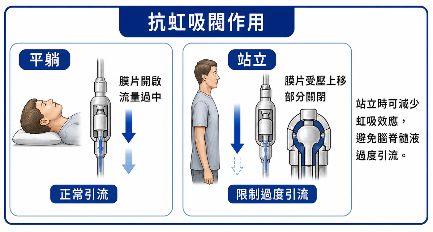 水腦症引流手術抗虹吸閥原理示意圖