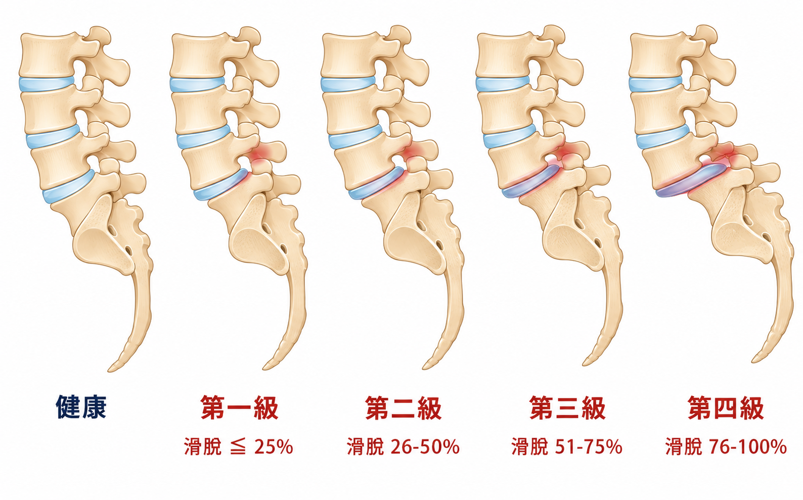 腰椎椎體滑脫造成神經通道變窄示意圖