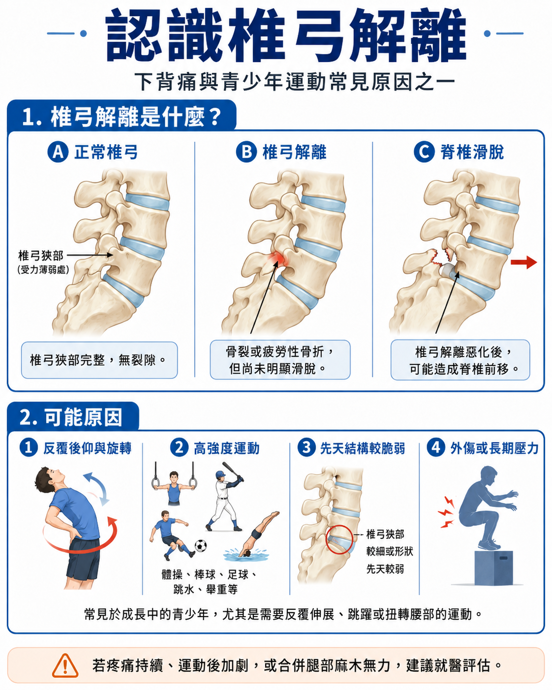 椎弓峽部裂隙與椎弓解離示意圖
